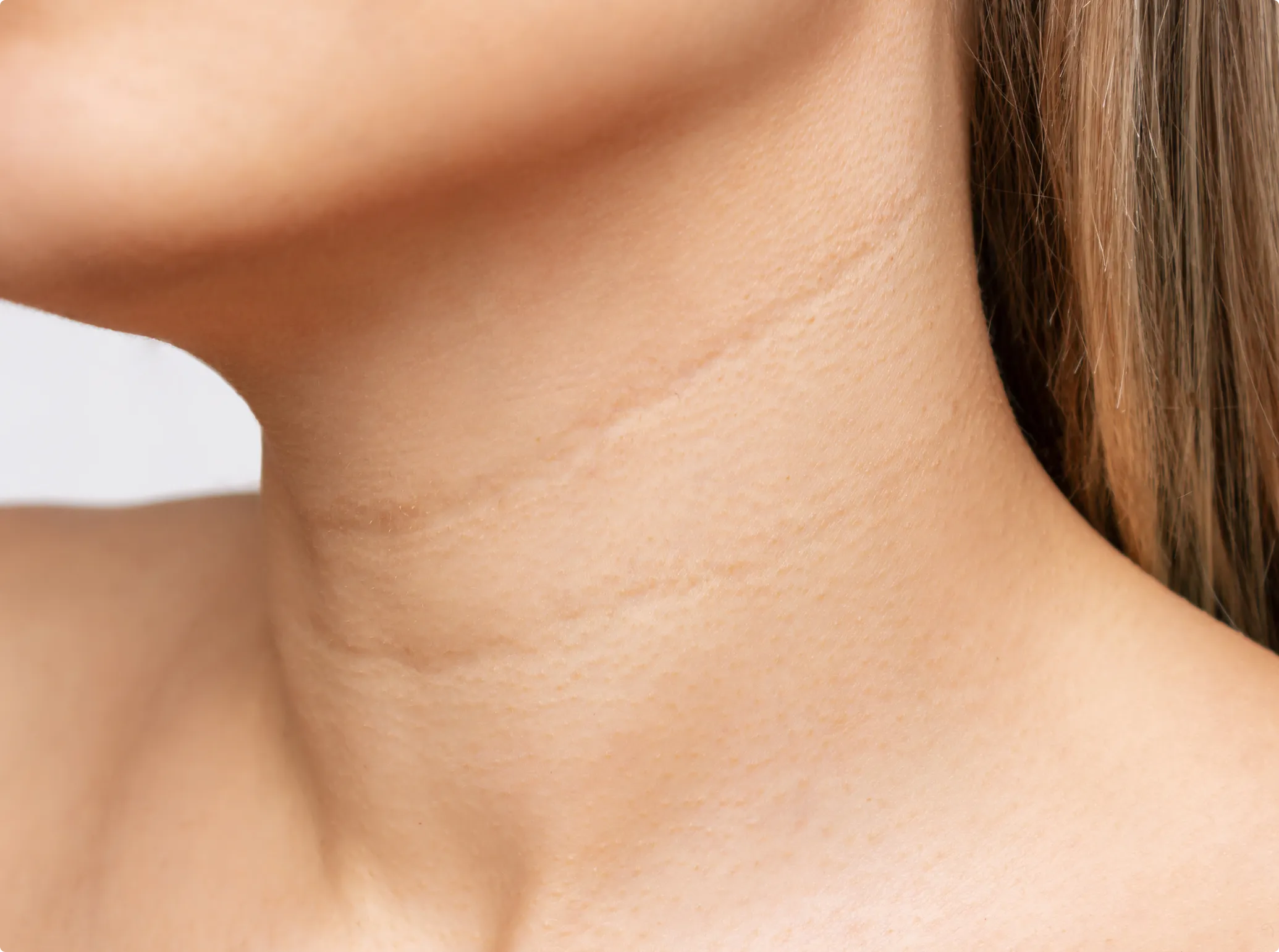Neck Lines Correction Treatment, before