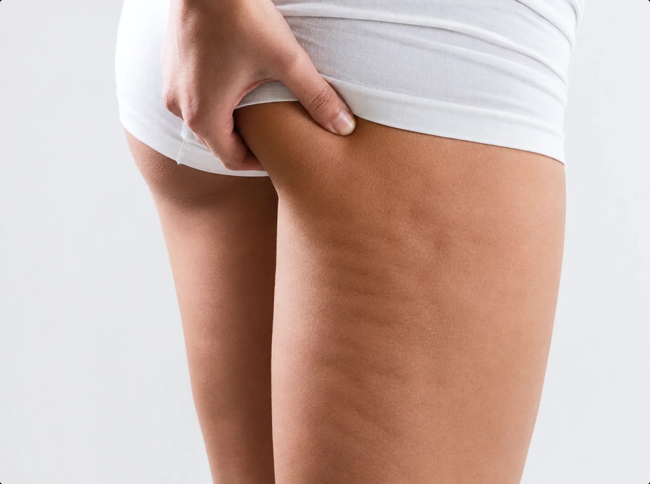 EMTONE – Cellulite Reduction, before